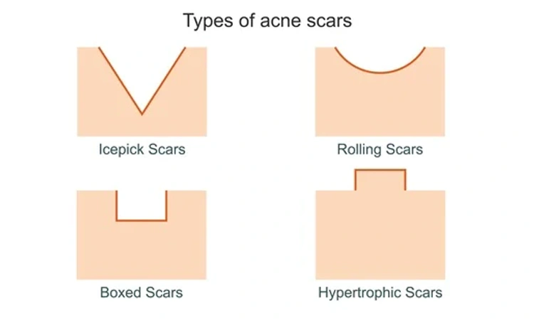 Are acne scars more than skin deep?